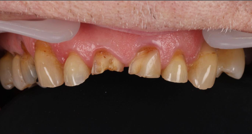Bone Grafting before treatment